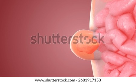 Medical Visualization of Human Abdominal Hernia Formation 3d illustration