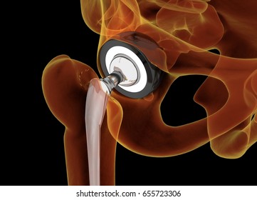 Medically accurate illustration of the hip replacement. 3d illustration.