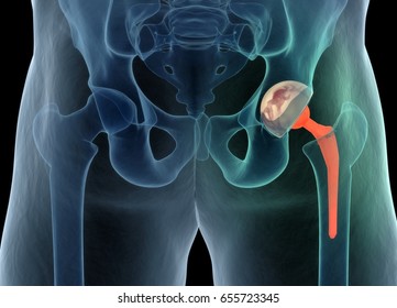 Medically accurate illustration of the hip replacement. 3d illustration.