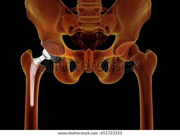 Medically Accurate Illustration Hip Replacement 3d Stock Illustration 655723333 Shutterstock 4909