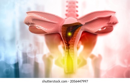 Medically accurate illustration of hysteroscopy of uterus. The appearance of the disease endometriosis. 3d illustration
