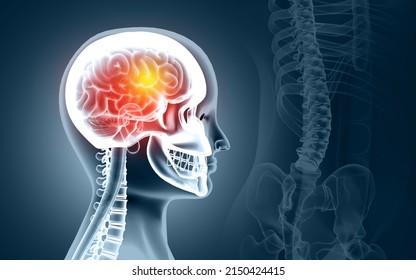 Medically Accurate Illustration Of A Painful Brain, Man With A Headache, Stoke, Blood Clot In The Vessels Of The Human Brain, 3d Illustration