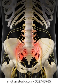 medically accurate illustration - painful sacral nerves