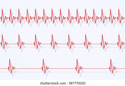 Fast heartbeat