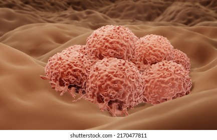 Melanoma, Skin Cancer 3d Illustration	