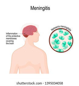 600 Meningitidis Images, Stock Photos & Vectors | Shutterstock