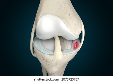 Meniscus Tear 3D Rendering, Knee Anatomy, Knee Pain