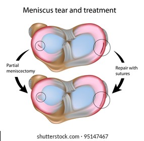 Meniscus tear and surgery