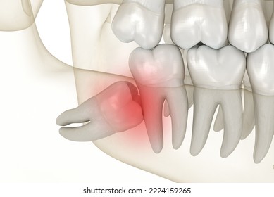 Mesial impaction of Wisdom teeth. Medically accurate tooth 3D illustration