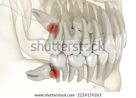 Mesial impaction of Wisdom teeth. Medically accurate tooth 3D illustration