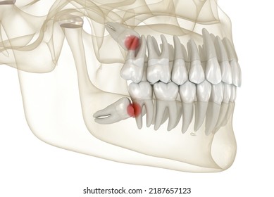 Mesial Impaction Of Wisdom Teeth To The Second Molar. Medically Accurate Tooth 3D Illustration