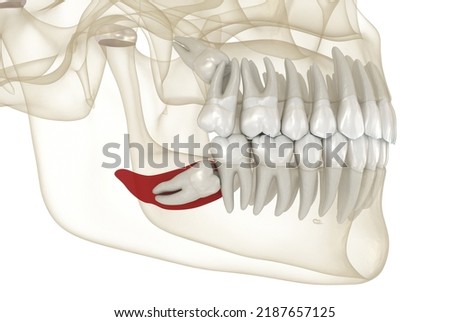 Mesial impaction of Wisdom tooth and bone inflammation. Medically accurate tooth 3D illustration