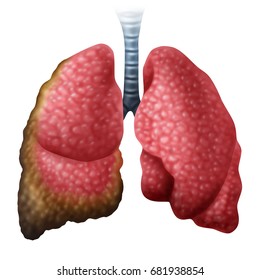 Mesothelioma Images, Stock Photos & Vectors | Shutterstock