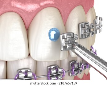 3,461 Braces installation Images, Stock Photos & Vectors | Shutterstock