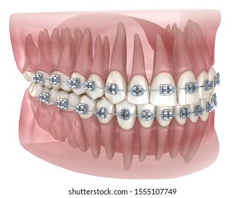 Metal braces and transparent dental model. Medically accurate 3D illustration - Shutterstock ID 1555107749