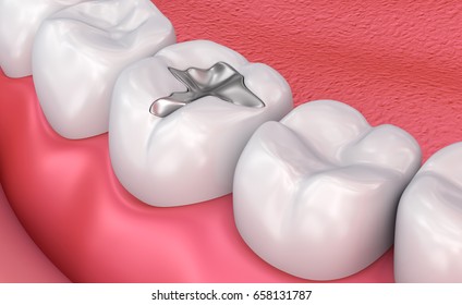 Metall dental fillings, Medically accurate 3D illustration