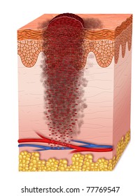 Metastasis Melanoma