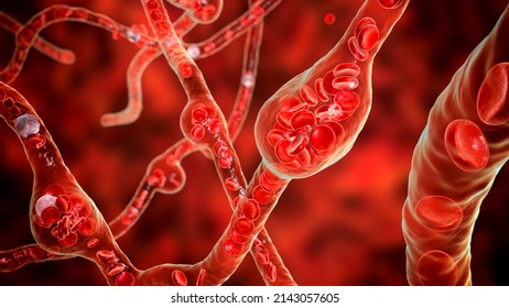 Microaneurysms, microscopic buldges in the artery walls filled with blood, 3D illustration. Found in the eye retina in diabetic retinopathy, and also in brain (Charcot-Bouchard aneurysms)