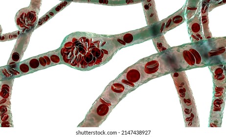 Microaneurysms, microscopic buldges in the artery walls filled with blood, 3D illustration. Found in the eye retina in diabetic retinopathy, and also in brain (Charcot-Bouchard aneurysms)