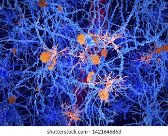 Microglia cells (red) play an important role in the pathogenesis of Alzheimer's disease. Microglia are specialised macrophages that restrain the accumulation of amyloid (orange plaques). 3d rendering