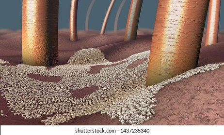 Microscopic close-up of a fungal infection of the upper skin layer, called skin mycosis - 3d illustration