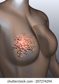 A Microscopic Conceptual Visualization Of Breast Cancer Cells On The Surface Of Breast Tissue. 
