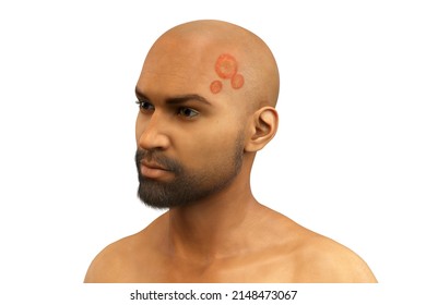 Microsporum Canis Fungal Infection On A Man's Head, 3D Illustration. Ringworm, Tinea Capitis