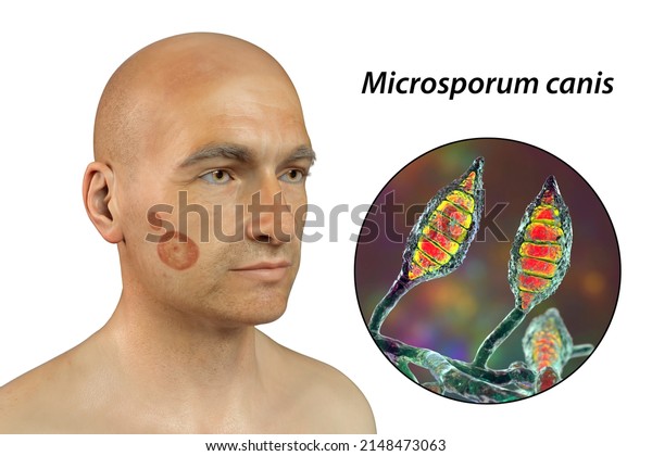 Microsporum Canis Fungal Infection On Mans Stock Illustration ...