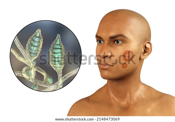 Microsporum Canis Fungal Infection On Mans Stock Illustration ...