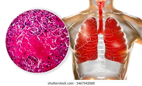 203 Tuberculosis Lesion Images, Stock Photos & Vectors | Shutterstock