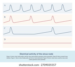 The mode of action potential produced by sinoatrial node is the mechanism of various sinus rhythm, including sinus tachycardia, sinus bradycardia and sinus arrest.
