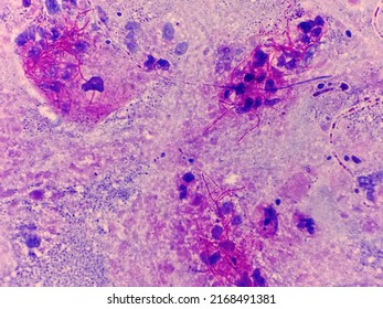 Modified Acid Fast Stain Positive, Nocardia In Sputum. Acis Fast Branching Filament On Blue Background.