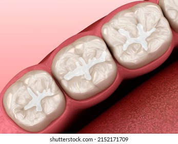 Molar Fissure Dental Fillings. Dental 3D Illustration