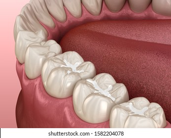 Molar Fissure dental fillings, Medically accurate 3D illustration of dental concept