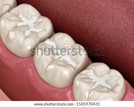 Molar Fissure dental fillings, Medically accurate 3D illustration of dental concept Сток-фото © 