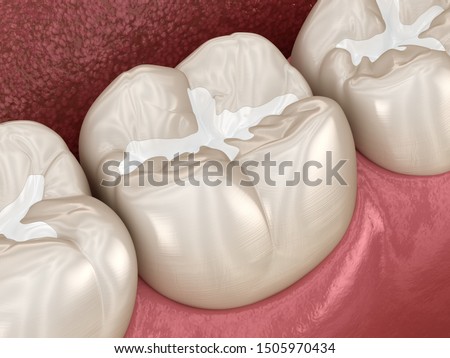 Molar Fissure dental fillings, Medically accurate 3D illustration of dental concept Сток-фото © 