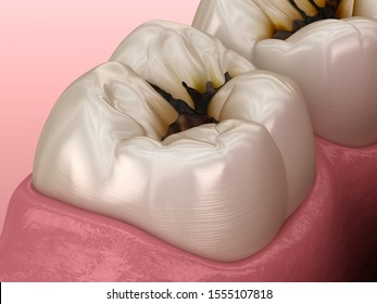 Molar Teeth Damaged By Caries. Medically Accurate Tooth 3D Illustration.