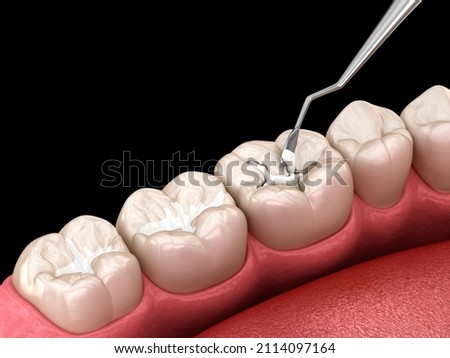 Molar tooth fissure restoration with filling. Medically accurate tooth 3D illustration. Сток-фото © 