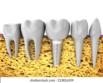 Molars And Implant In The Jaw Bone, 3d Render