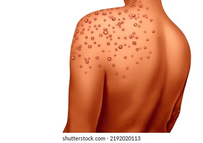 Monkeypox or Monkey Pox Virus Outbreak as a contagious infection as blisters and leisons on the skin representing transmission of an infected person with 3D illustration elements.