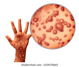 Monkeypox Virus Infection Outbreak As A Contagious Disease As Blisters And Leisons On The Skin Representing Transmission Of An Infected Person In A 3D Illustration Style.