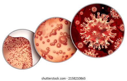 Monkeypox-Virusausbruch als ansteckende Infektion als Blasen und Leisten auf der Haut, die die Übertragung einer infizierten Person mit 3D-Illustrationselementen darstellen.