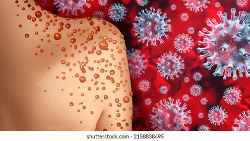 Monkeypox Virus Outbreak as a contagious infection as blisters and leisons on the skin representing transmission of an infected person with 3D illustration elements.