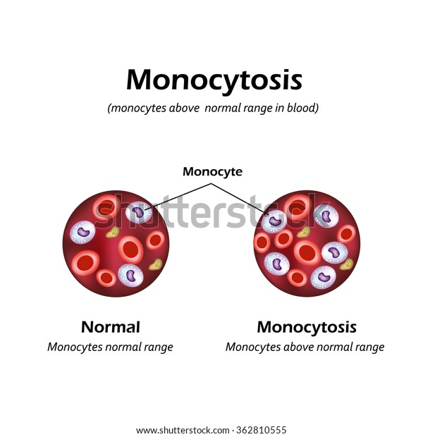 monocytes-above-normal-range-blood-monocytosis-stock-illustration-362810555