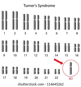 Monosomy X, Turner Syndrome