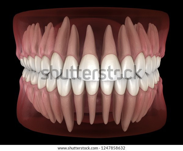 下顎骨と上顎のヒト歯茎と歯の形態 医学的に正確な歯の3dイラスト のイラスト素材