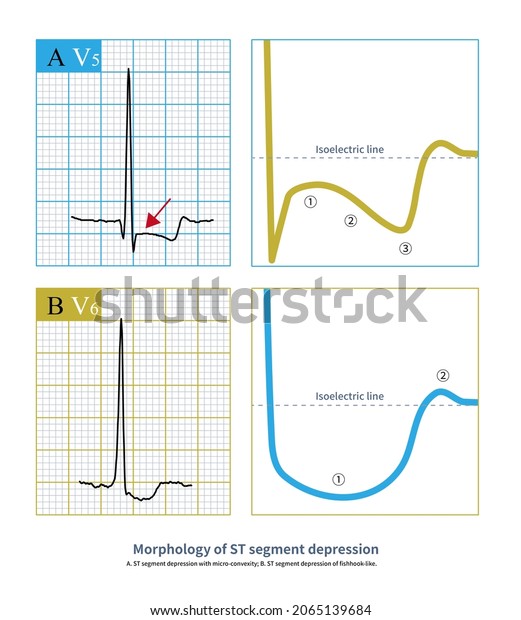 Morphology St Segment Depression Carefully Analyzed Stock Illustration ...