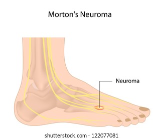 Morton's Neuroma