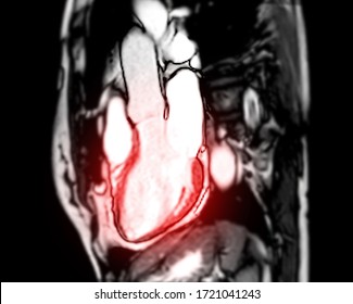 MRI Heart Or Cardiac MRI ( Magnetic Resonance Imaging ) Of Heart LVOT For Diagnosis Heart Disease.