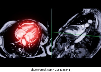 Mri Heart Cardiac Mri Magnetic Resonance Stock Illustration 2184338341 ...